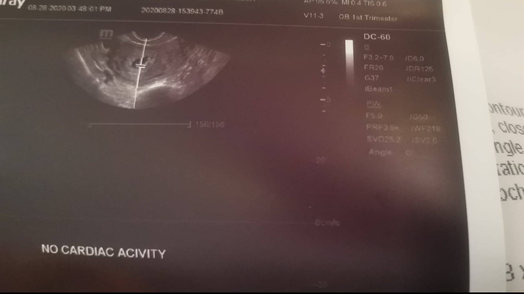 A 15-Week Long Miscarriage